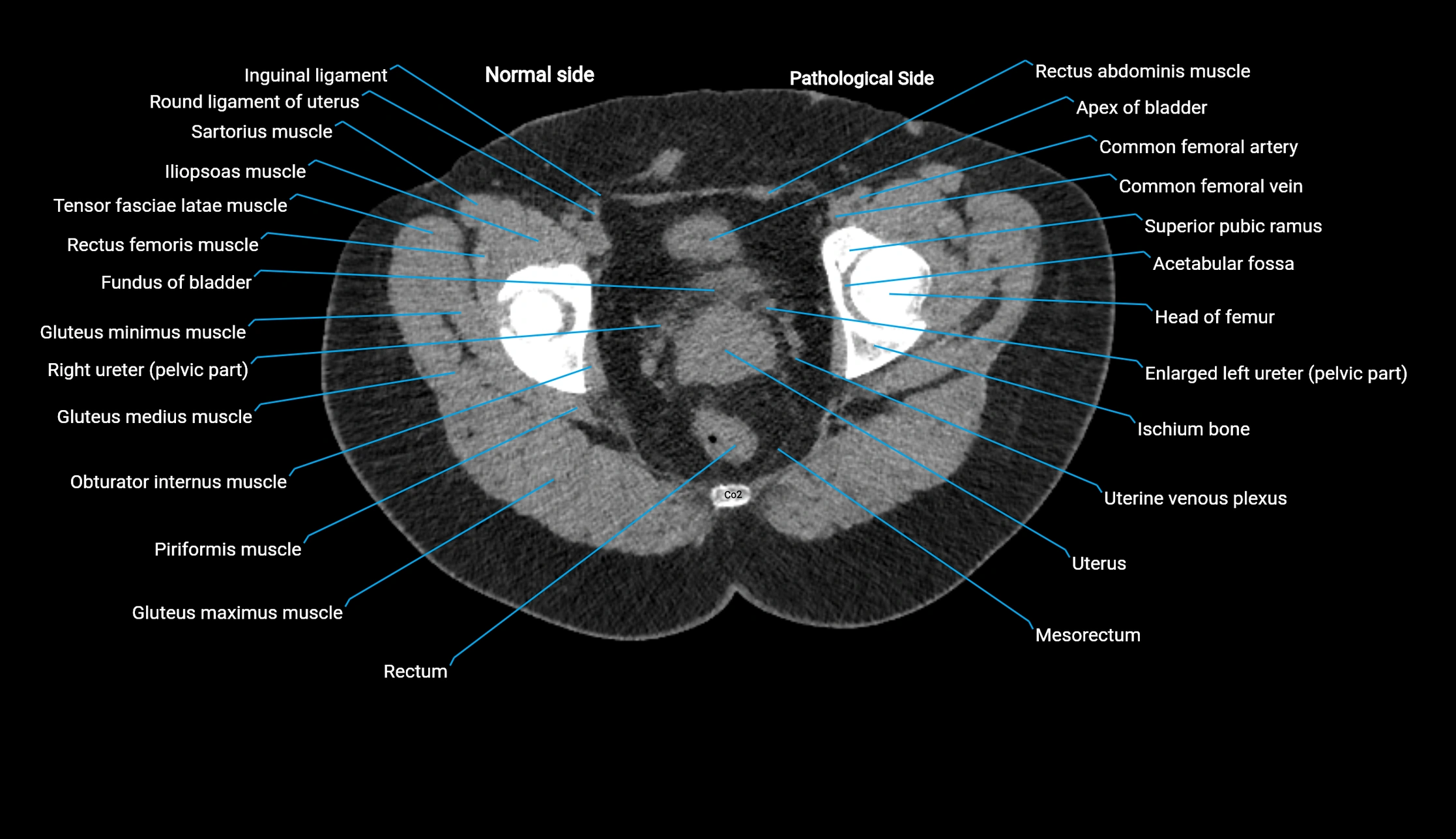 CT KUB axial cross sectional anatomy  radiology image -img-00201-00155.webp